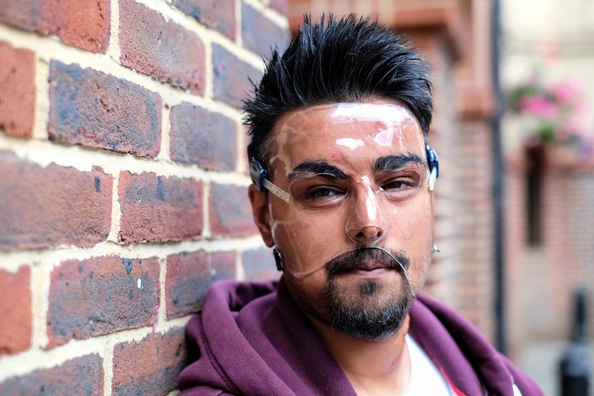 Samir Hussain wearing a face mask - which he keeps on 24 hours a day - as he recovered from burns suffered in an acid attack. (file pic) See National News story NNACID; Two men have admitted their part in throwing acid in a cinema-goer's face outside a screening of Straight Outta Compton after shouting "you can seen gangsters now". Samir Hussain was left with life-changing injuries from the horrific burns following the attack at a Cineworld. The 28-year-old still has to wear a face mask 18 months after the attack in Crawley, West Sussex, in August 2015. Michael McPherson, 27, of Tooting Bec, south London, who threw sulphuric acid in Samir's face, previously admitted grievous bodily harm and will be sentenced at a later date. Lee Bates, 26, of Clapham, south west London, who was with McPherson at the time of the attack and punched Samir, admitted common assault and was sentenced today to a two-year conditional discharge at Brighton Magistrates' Court on Monday.