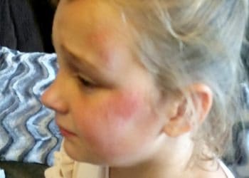 A ten-year-old girl suffered a broken arm after she was struck by a "knife-wielding" boy dressed as a killer CLOWN. See SWNS story SWCLOWN.  Casie Morrison, ten, was playing in the park with her siblings when a figure emerged from the bushes dressed as a creepy clown wearing a Slender Man mask.  Mum Kirsty, 36, told the boy - who was reportedly carrying a KNIFE - to clear off, and he fled when older boys in the park gave chase.  But the boy barged passed Casie, who was on her bike at the time, causing her to fall to the ground and suffer a broken arm as well as cuts and grazes.  Her furious mum said the boy was trying to terrifying other kids in the park and she has since found out he was aged just NINE.  Police were called following the incident and have spoken to the boy responsible.