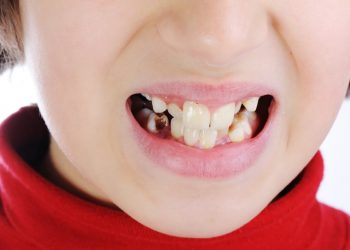 Bad child teeth