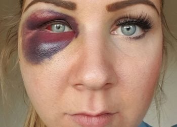 The injuries inflicted on Jennifer Salter by Richard Robson. Credit;SWNS