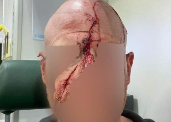 The victim suffered horffic injuries during the attack. Credit;SWNS
